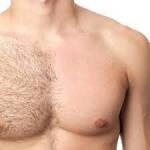Laser Hair Reduction for Men